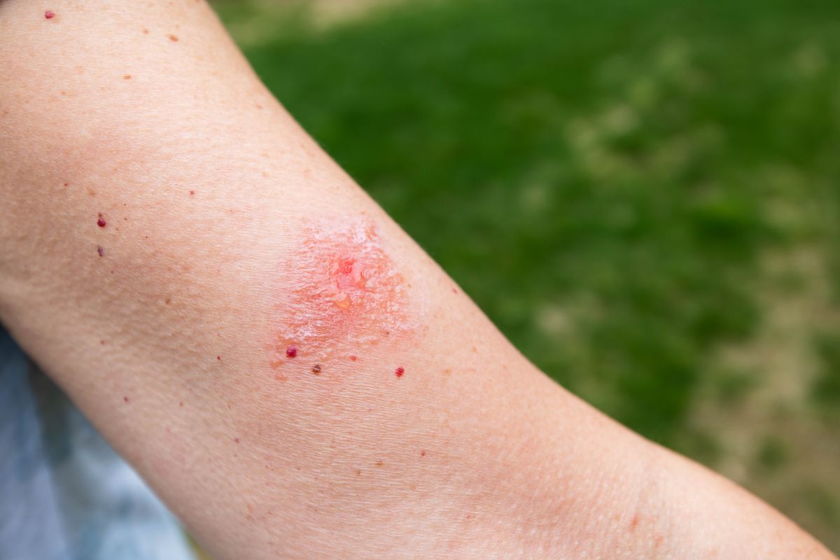 Poison ivy rash on skin