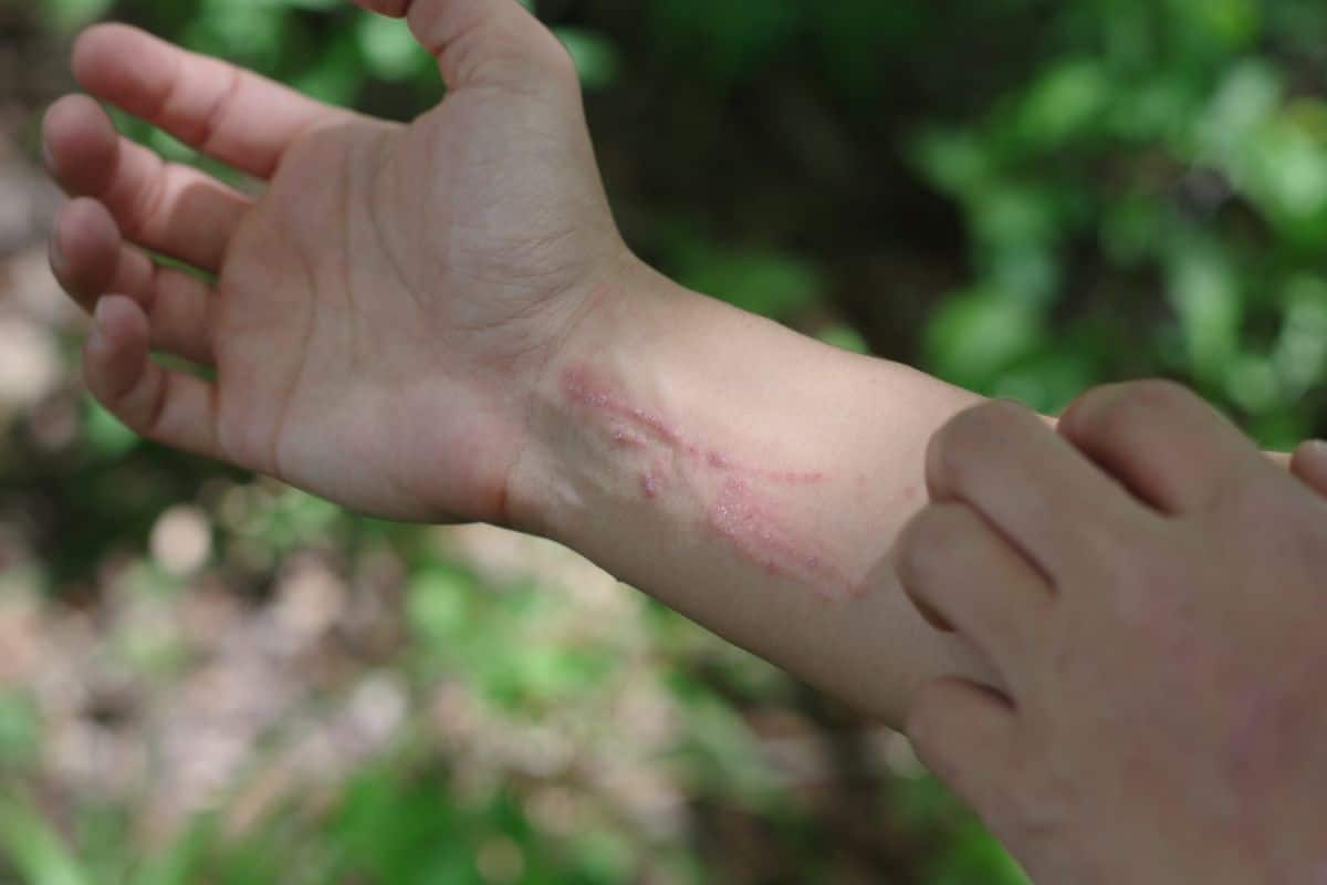 A person with a poison ivy rash on their arms