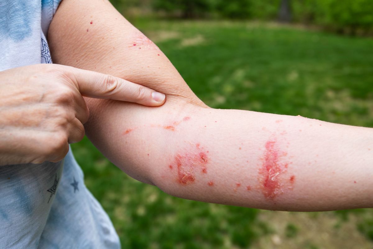 A person shows their poison ivy rash